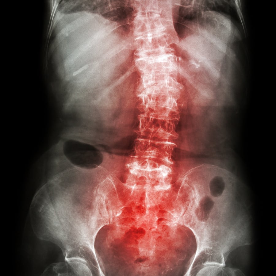 film-x-ray-lumbar-sacrum-spine-show-crooked-spine